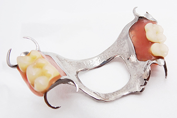部分金属床義歯
